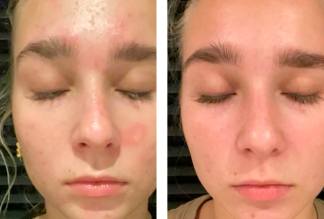 Før og efter brugen af UniSkin hudpleje serie