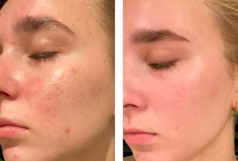 foer_efter_472x320px_Line_19