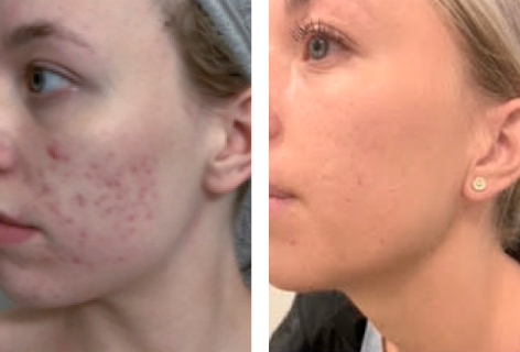 før og efter brug af UniSkin hudpleje serie