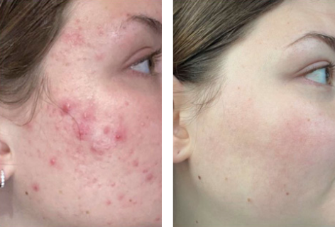 Før og efter UniSkin hudpleje serie