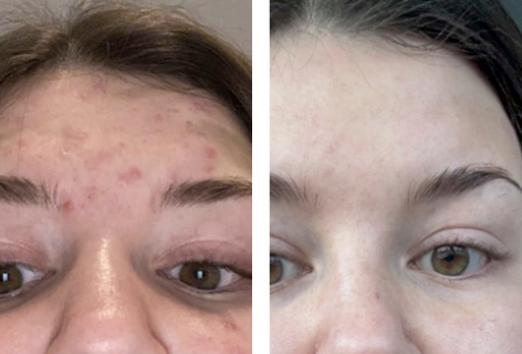 foer_efter_472x320px_katrine_22_2