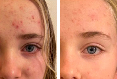 før og efter UniSkin hudpleje